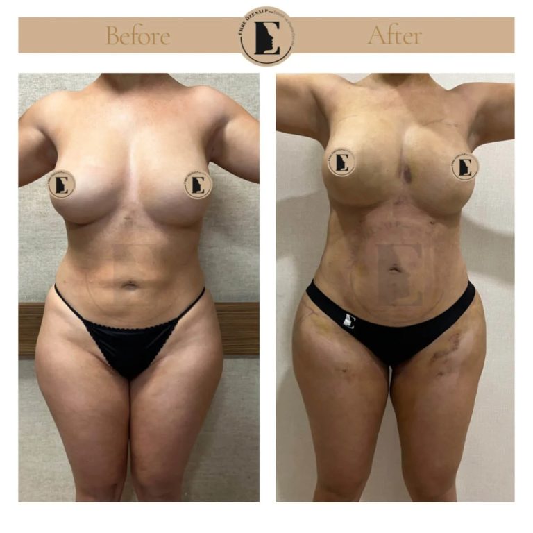 imgi_105_liposuction-before-after-in-turkey-results-13.jpg