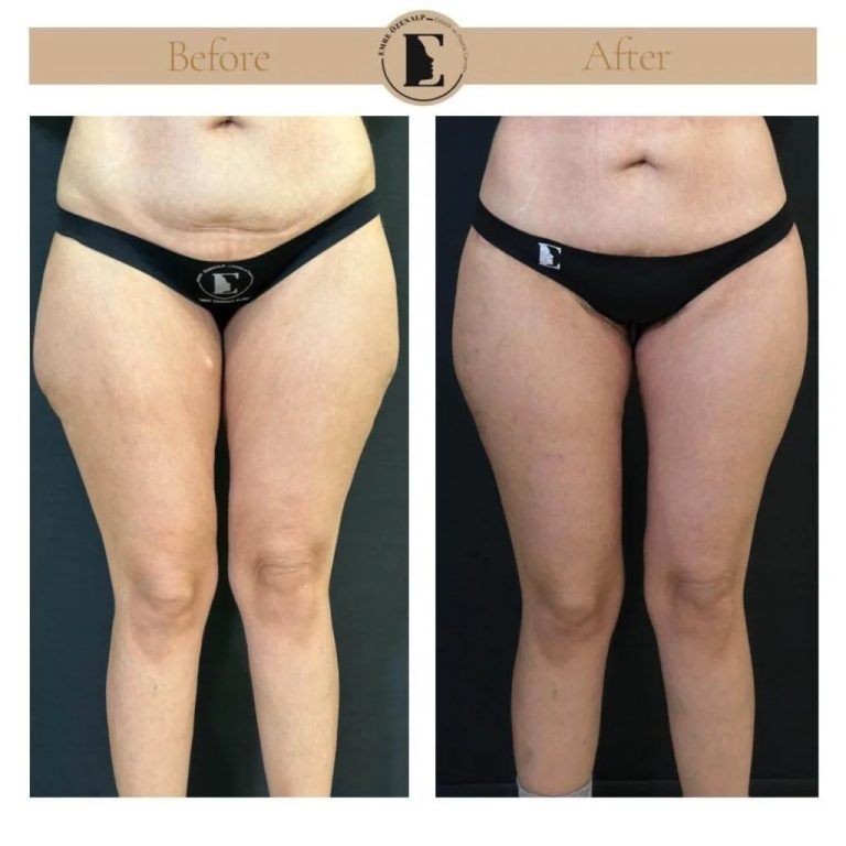 imgi_10_thigh-lift-in-Turkey-before-after-01-1024x1024.jpg