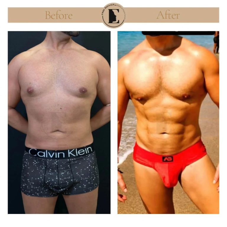 imgi_111_liposuction-hi-def-before-after-i-turkey-01.jpeg