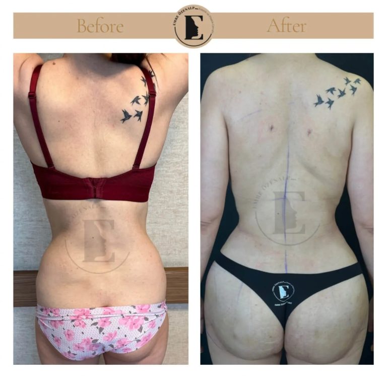 imgi_113_BBL-before-after-in-Turkey-07.jpeg