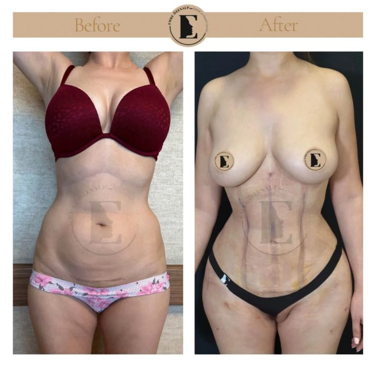 imgi_117_liposuction-before-after-in-turkey-results-12.jpg