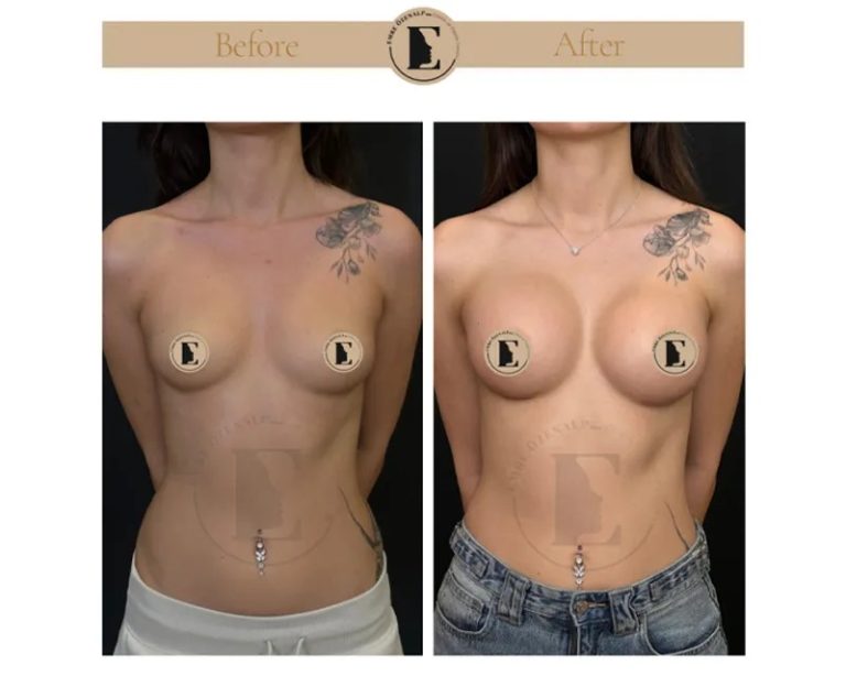 imgi_11_boob-job-breast-augmentation-in-turkey-before-after-09