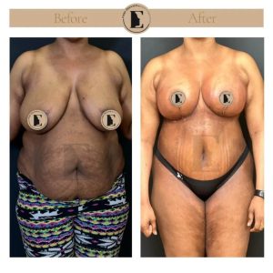imgi_11_mommy-makeover-in-turkey-before-after-34-1024x1024.jpeg