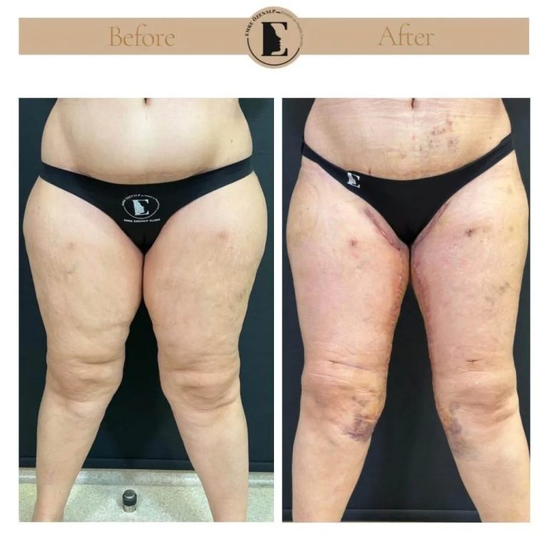 imgi_11_thigh-lift-in-Turkey-before-after-05-1024x1024.jpg