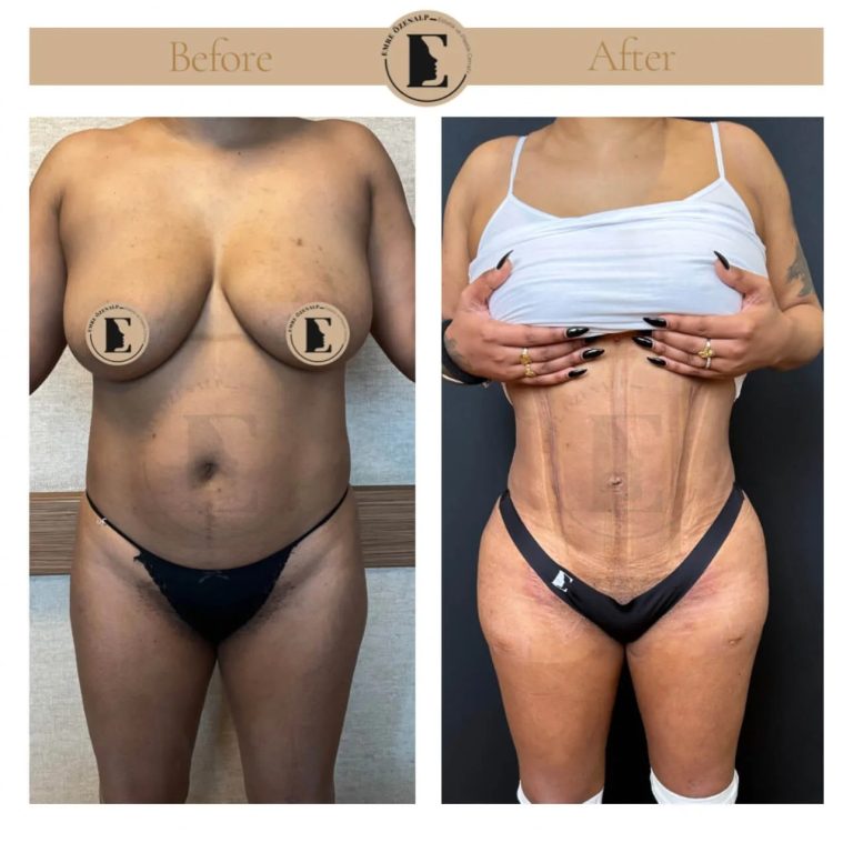 imgi_124_liposuction-before-after-in-turkey-results-11.jpg