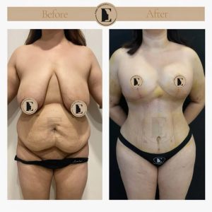 imgi_12_mommy-makeover-in-turkey-before-after-33-1024x1024.jpeg