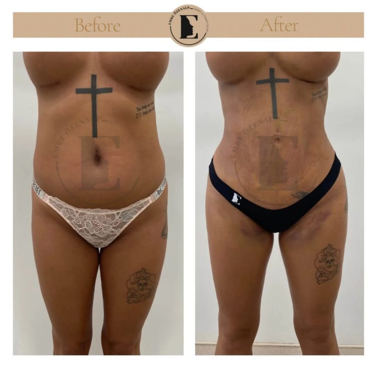 imgi_131_liposuction-before-after-in-turkey-results-10.jpg