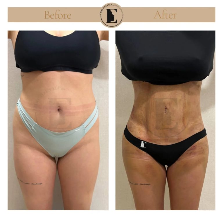 imgi_138_liposuction-before-after-in-turkey-results-09.jpg