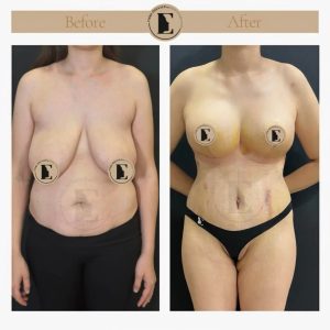 imgi_13_mommy-makeover-in-turkey-before-after-32-1024x1024.jpeg
