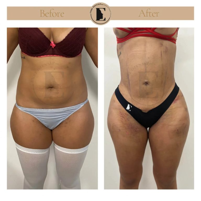 imgi_145_liposuction-before-after-in-turkey-results-08.jpg