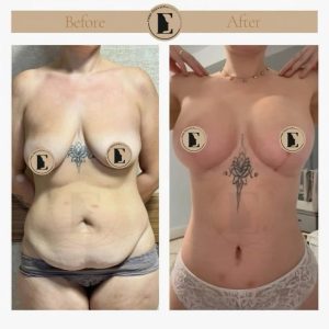 imgi_14_mommy-makeover-in-turkey-before-after-31-1024x1024.jpeg