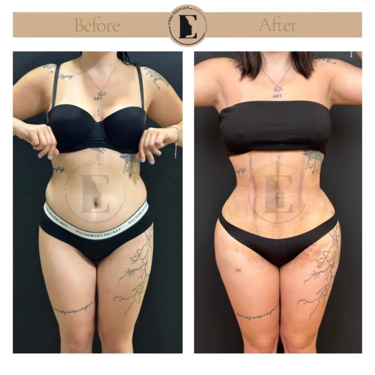 imgi_152_liposuction-before-after-in-turkey-results-07.jpg