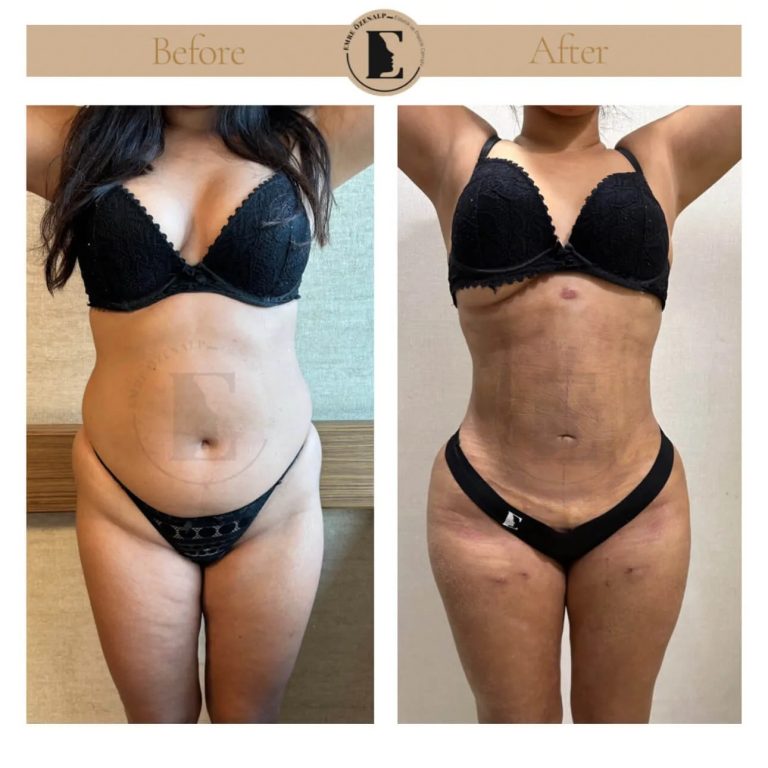 imgi_159_liposuction-before-after-in-turkey-results-06.jpg