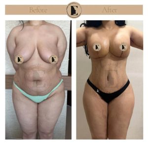 imgi_15_mommy-makeover-in-turkey-before-after-30-1024x1024.jpeg