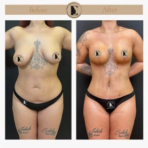 imgi_16_mommy-makeover-in-turkey-before-after-29-1024x1024.jpeg