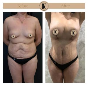 imgi_17_mommy-makeover-in-turkey-before-after-28-1024x1024.jpeg