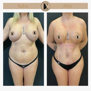 imgi_18_mommy-makeover-in-turkey-before-after-27-1024x1024.jpeg