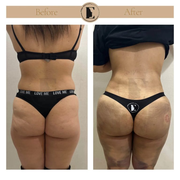 imgi_195_BBL-before-after-in-Turkey-19.jpeg