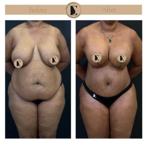 imgi_19_mommy-makeover-in-turkey-before-after-26-1024x1024.jpeg