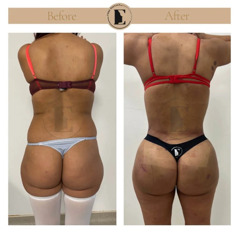 imgi_209_BBL-before-after-in-Turkey-21.jpeg