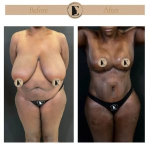 imgi_20_mommy-makeover-in-turkey-before-after-25-1024x1024.jpeg