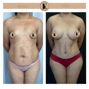 imgi_21_mommy-makeover-in-turkey-before-after-24-1024x1024.jpeg
