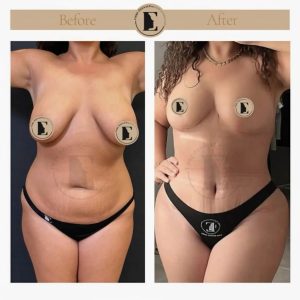 imgi_25_mommy-makeover-in-turkey-before-after-20-1024x1024.jpeg