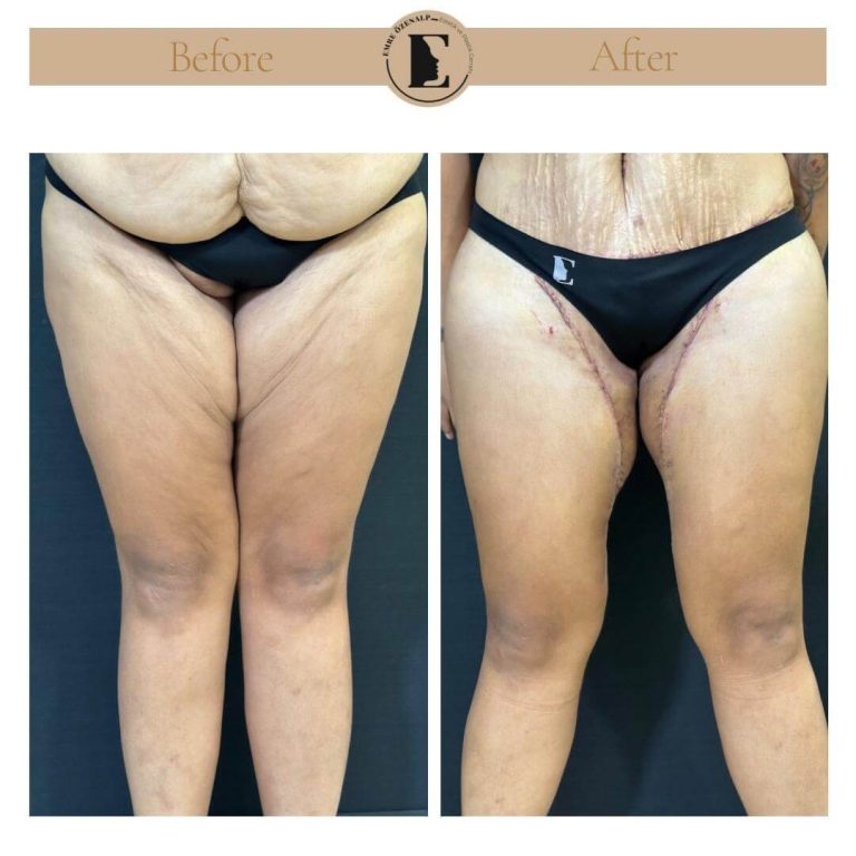 imgi_26_thigh-lift-in-Turkey-before-after-04