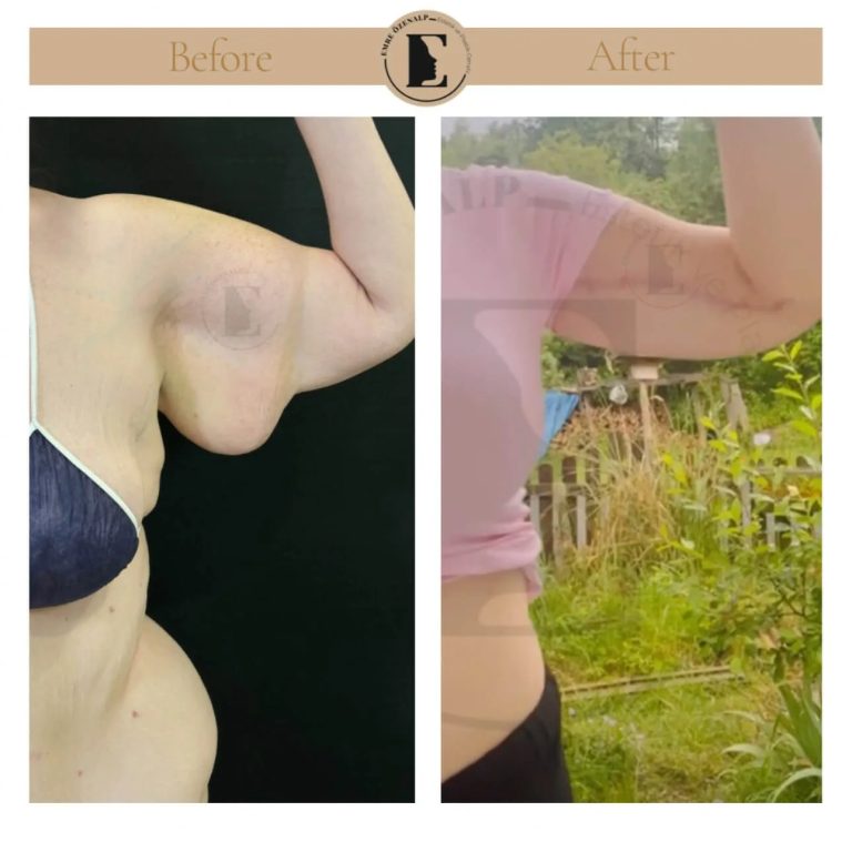 imgi_27_arm-lift-in-turkey-before-after-3.jpeg