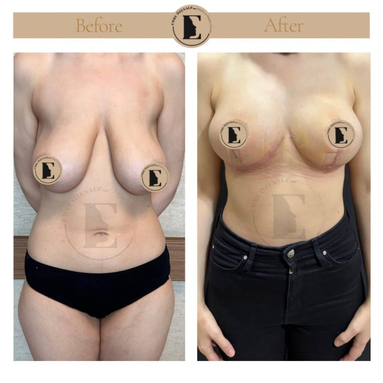 Turkey breast lift before and after showing lifted position