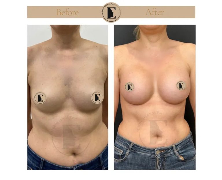 imgi_28_boob-job-breast-augmentation-in-turkey-before-after-07