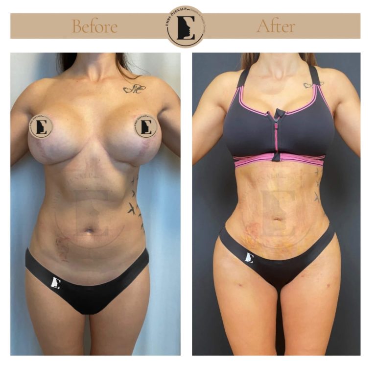 imgi_28_liposuction-before-after-in-turkey-results-18
