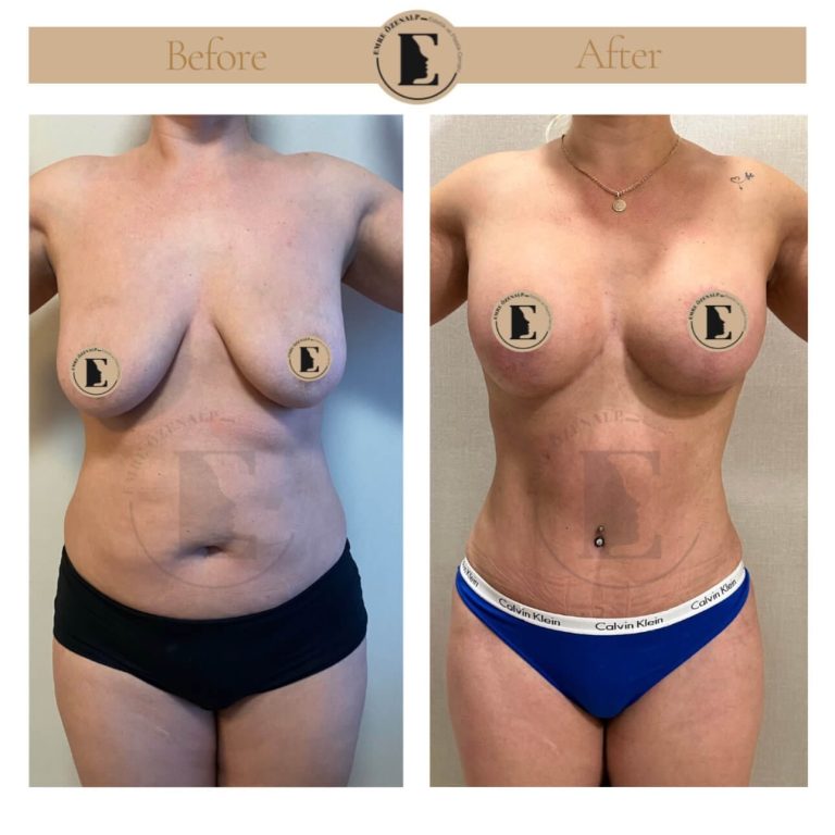 Before after periareolar breast lift results Turkey