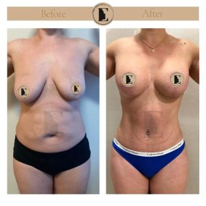 imgi_29_mommy-makeover-in-turkey-before-after-16-1024x1024.jpeg