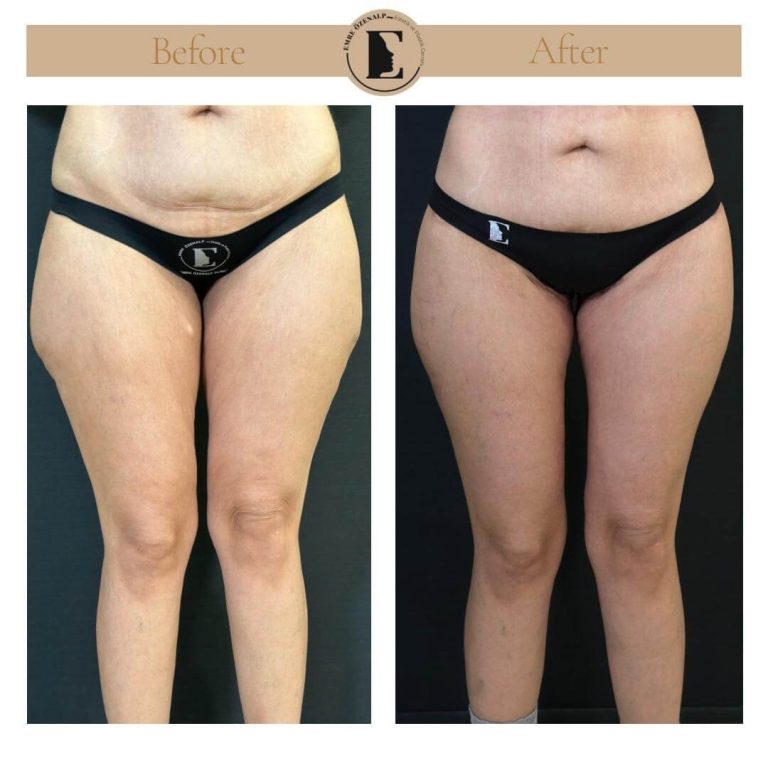 imgi_29_thigh-lift-in-Turkey-before-after-01