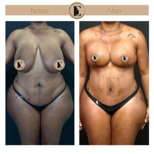 imgi_30_mommy-makeover-in-turkey-before-after-15-1024x1024.jpeg