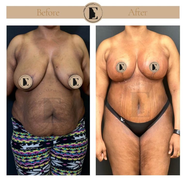 imgi_31_boob-reduction-in-turkey-before-after-07
