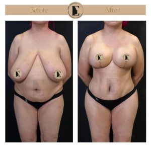 imgi_31_mommy-makeover-in-turkey-before-after-14-1024x1024.jpeg