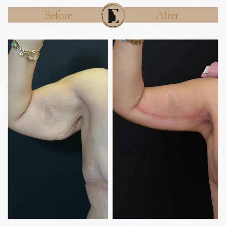imgi_32_arm-lift-in-turkey-before-after-2.jpeg