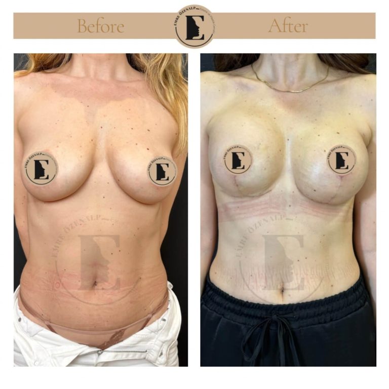 Before after mastopexy surgery results Turkey