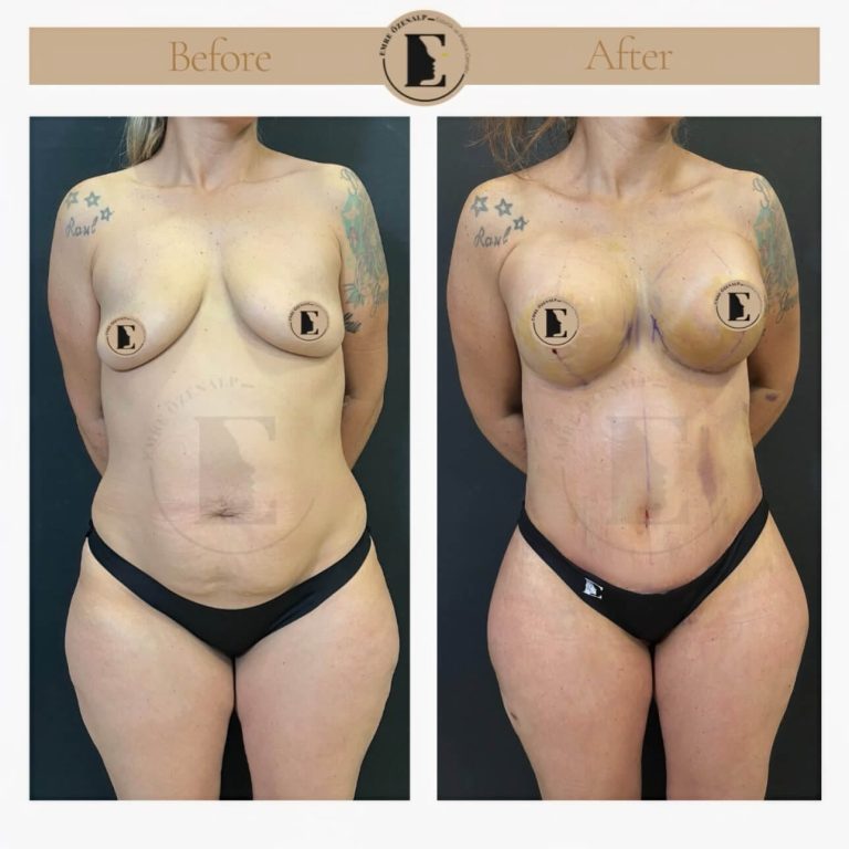 Breast lift in Istanbul Turkey before after patient results