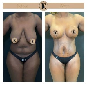 imgi_33_mommy-makeover-in-turkey-before-after-12-1024x1024.jpeg