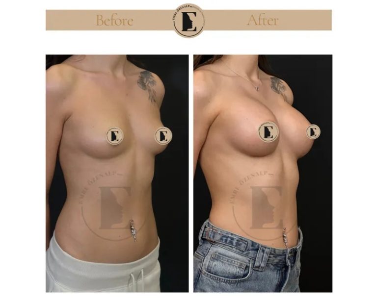 imgi_34_boob-job-breast-augmentation-in-turkey-before-after-05