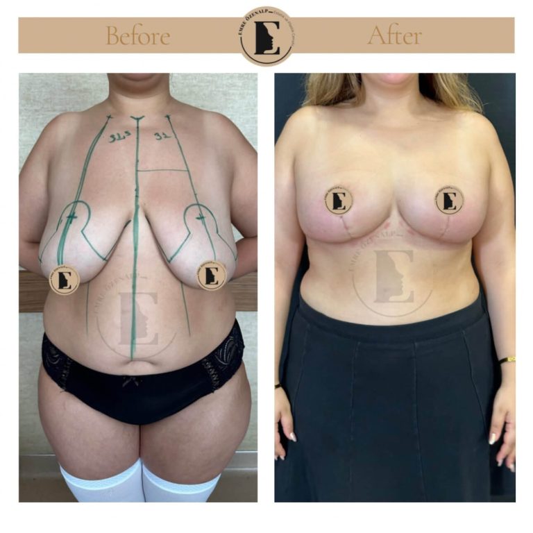 imgi_34_boob-reduction-in-turkey-before-after-11