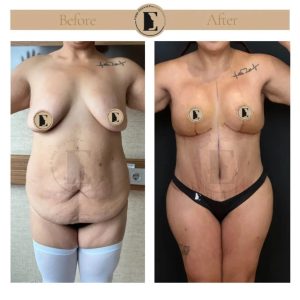 imgi_34_mommy-makeover-in-turkey-before-after-11-1024x1024.jpeg
