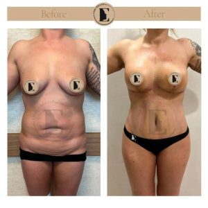 imgi_35_mommy-makeover-in-turkey-before-after-10-1024x1024.jpeg