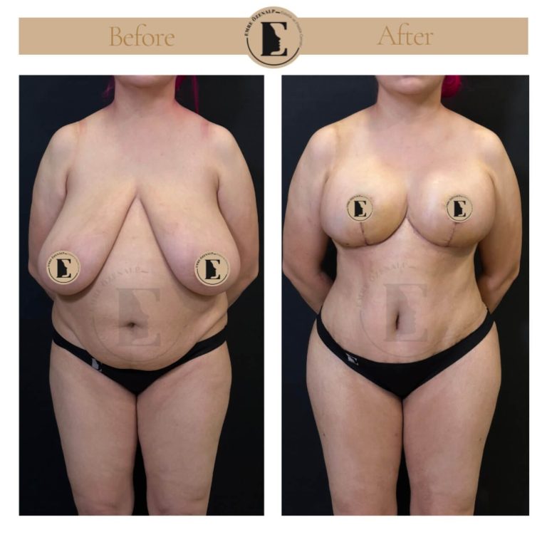 imgi_36_boob-reduction-in-turkey-before-after-02
