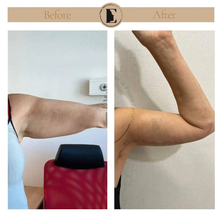imgi_37_arm-lift-in-turkey-before-after-1.jpeg