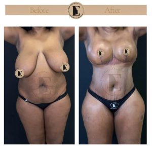 imgi_37_mommy-makeover-in-turkey-before-after-08-1024x1024.jpeg