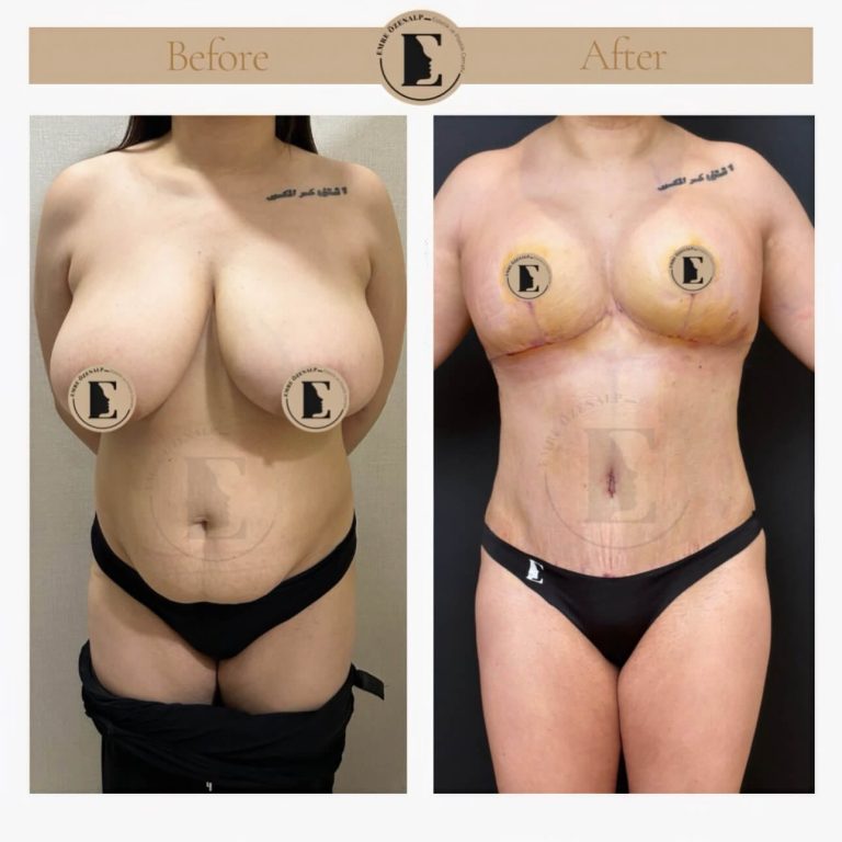 imgi_38_boob-reduction-in-turkey-before-after-03